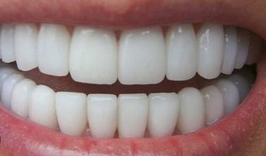 Implantet Dentare – Zgjidhja Moderne për Zëvendësimin e Dhëmbëve